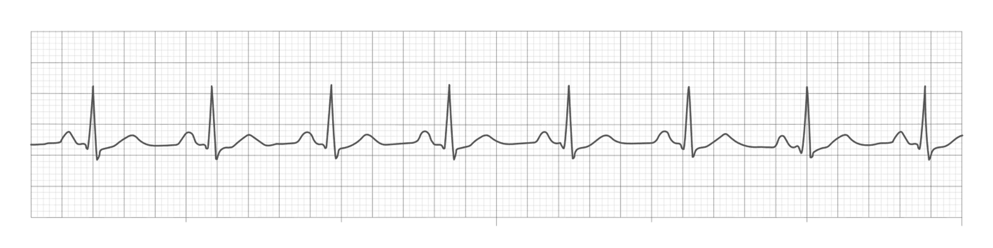 Two Consecutive R Waves Continuing education - NP Skills Made Easy